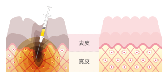 注射によりPFCを真皮まで届けることにより成長因子が肌を活性化