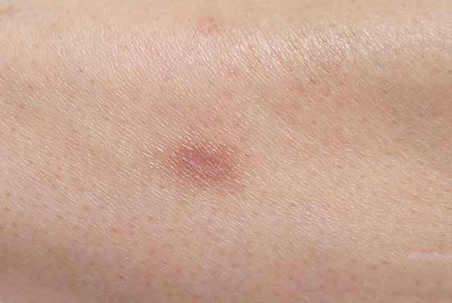 ニキビ ニキビ跡 荻窪の皮膚科 かおるクリニック ニキビ ニキビ跡 荻窪の皮膚科 かおるクリニック